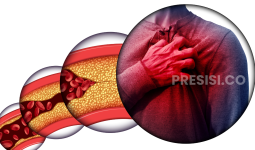 Atasi Sumbatan Pembuluh Darah Tanpa Operasi Besar: Kenali ABI dan Keunggulan PTA