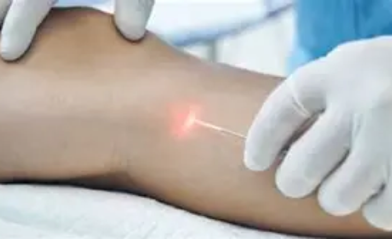 Benarkah Terapi Laser Jadi Solusi Modern Atasi Varises? Simak Penjelasannya!