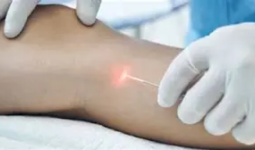 Benarkah Terapi Laser Jadi Solusi Modern Atasi Varises? Simak Penjelasannya!