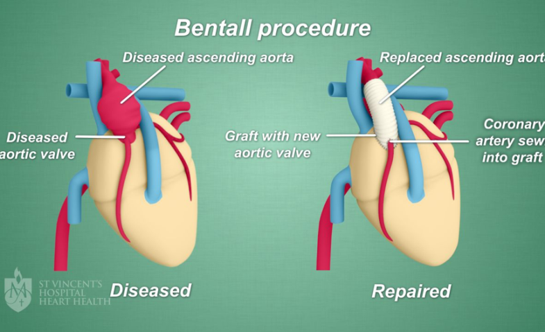 Bentall Procedure Jadi Terobosan Teknologi Terkini dalam Bedah Jantung