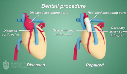 Bentall Procedure Jadi Terobosan Teknologi Terkini dalam Bedah Jantung