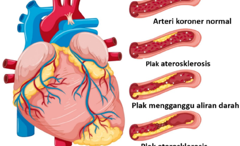 Penyakit Jantung Koroner: Kenali, Cegah, dan Tangani Sejak Dini