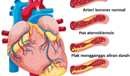 Penyakit Jantung Koroner: Kenali, Cegah, dan Tangani Sejak Dini