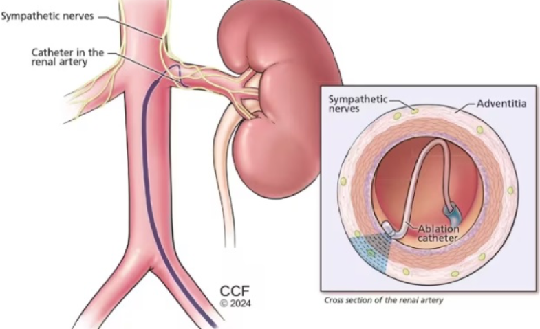 Terobosan Atasi Hipertensi, RS Jantung dan Pembuluh Darah Harapan Kita Hadirkan Layanan Renal Denervasi