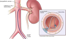 Terobosan Atasi Hipertensi, RS Jantung dan Pembuluh Darah Harapan Kita Hadirkan Layanan Renal Denervasi