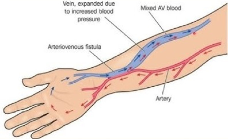 Peran USG Duplex dan Intervensi Dini untuk Menjaga Akses Tetap Optimal