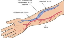 Peran USG Duplex dan Intervensi Dini untuk Menjaga Akses Tetap Optimal