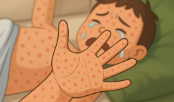 Waspada Penularan Campak, Dinkes Kaltim Ingatkan Orang Tua Lengkapi Imunisasi Anak Jelang Lebaran