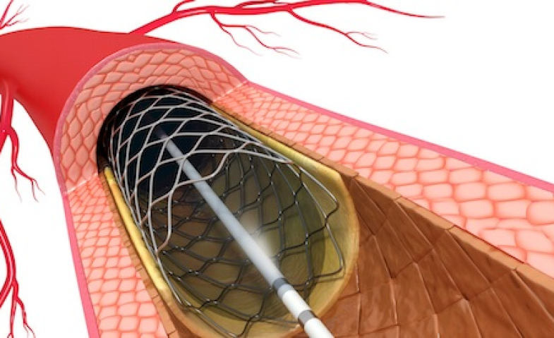 Disarankan CABG tapi Takut Operasi? Kenali PCI Complex Tanpa Belah Dada