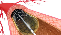 Disarankan CABG tapi Takut Operasi? Kenali PCI Complex Tanpa Belah Dada