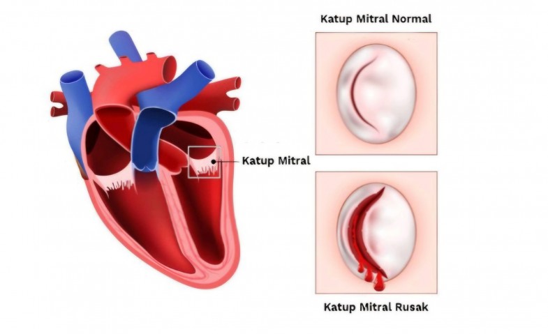 TEER: Inovasi Perbaikan Katup Mitral Tanpa Operasi Jantung Terbuka