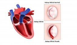 TEER: Inovasi Perbaikan Katup Mitral Tanpa Operasi Jantung Terbuka